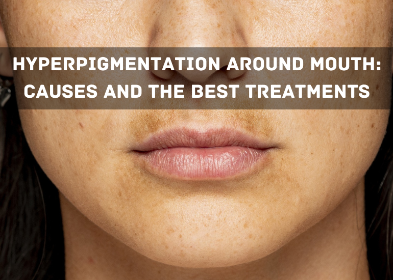 Hyperpigmentation Around Mouth: Causes And The Best Treatments