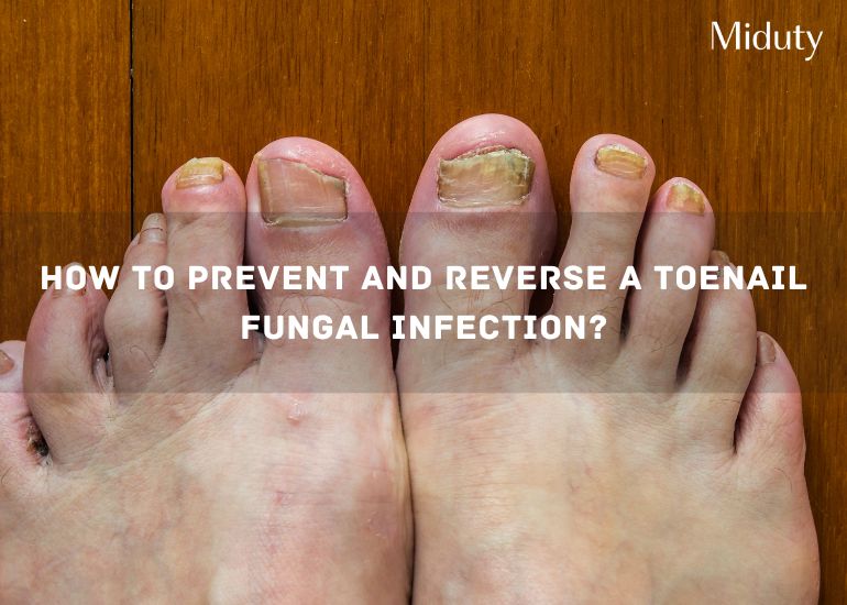 How to Prevent and Reverse a Toenail Fungal Infection?